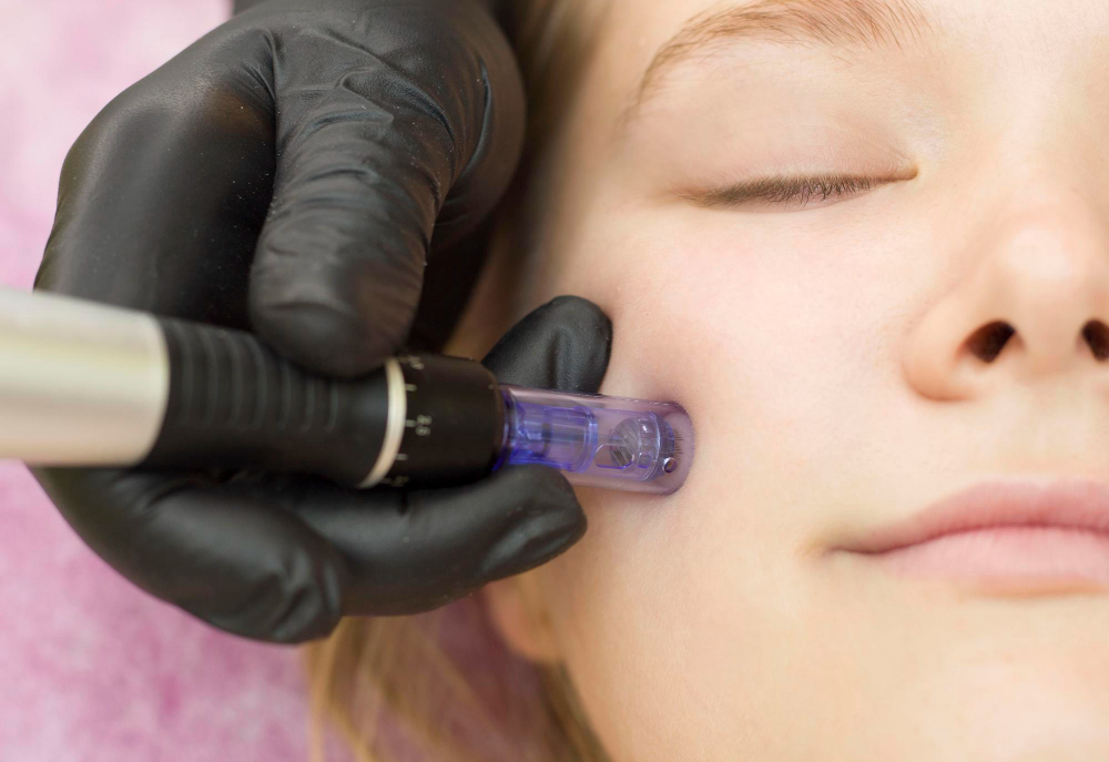 Radiofrequency Microneedling PA