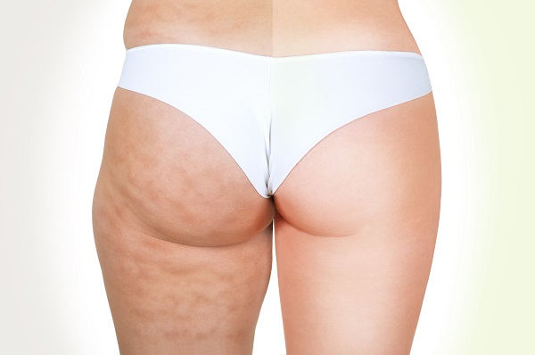 Cellulite Treatment