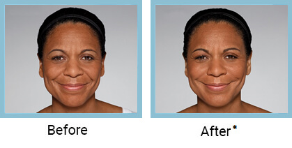 Restylane Refyne