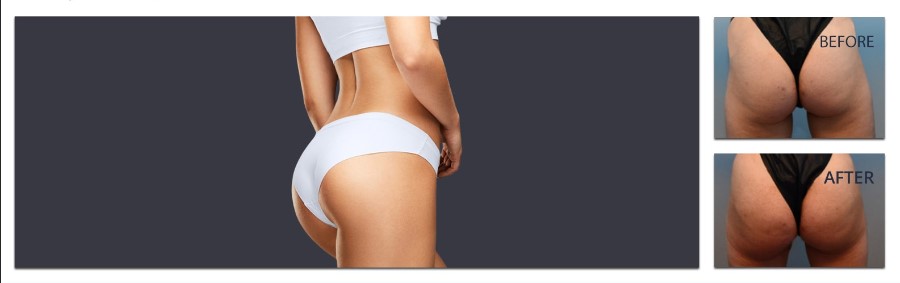 pa Sculptra Butt Lift