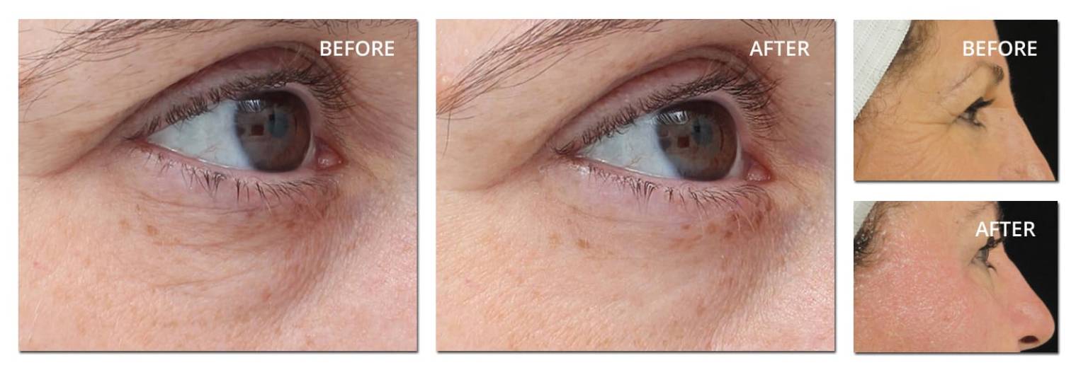 TempSure Envi