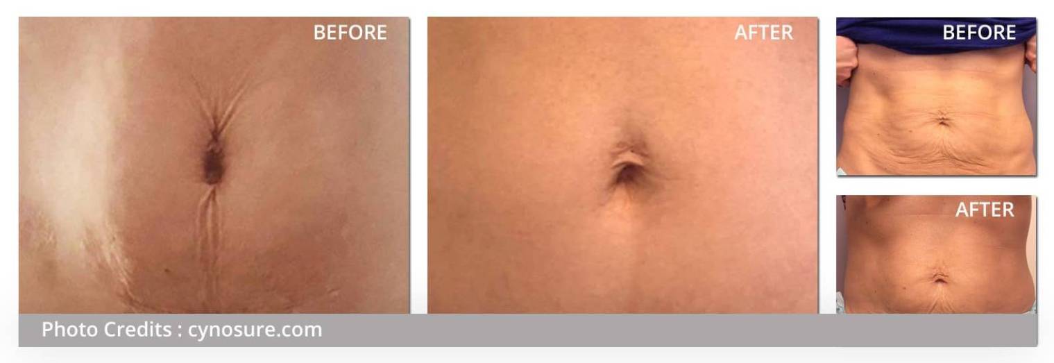 Tempsure Firm