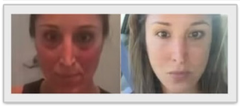 Vampire Facial before after