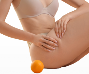 Get Summer-Ready Legs with Aveli Cellulite Reduction at The Falcone Center