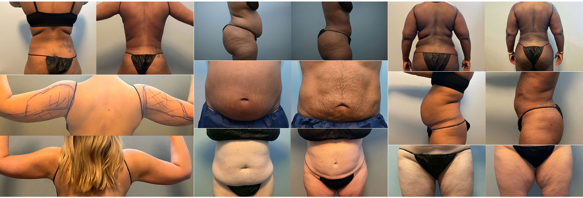 PA Liposuction