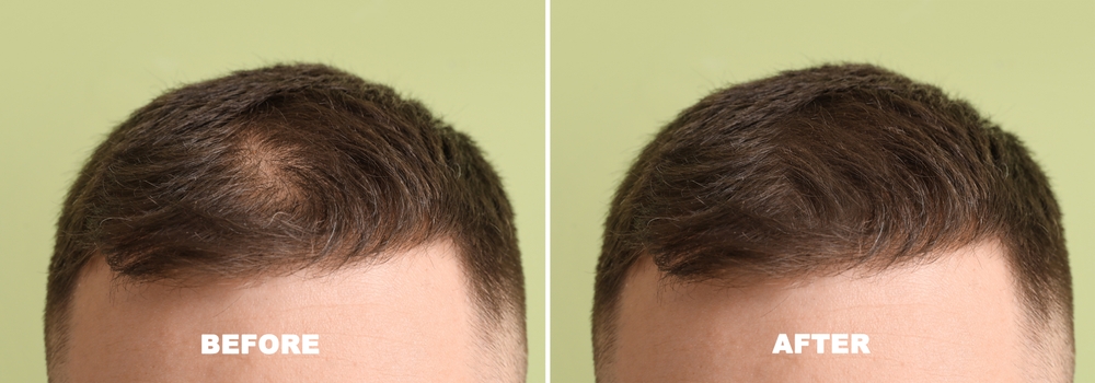 Alma TED vs. PRP: Which Is Better for Non-Surgical Hair Restoration?