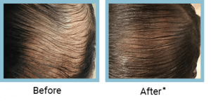 ACell Treatment