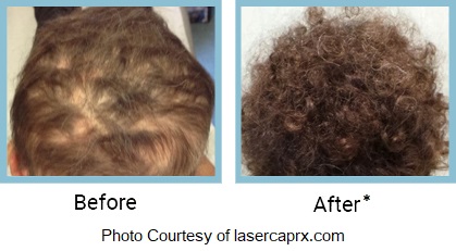 Hair Loss Treatment - Philadelphia