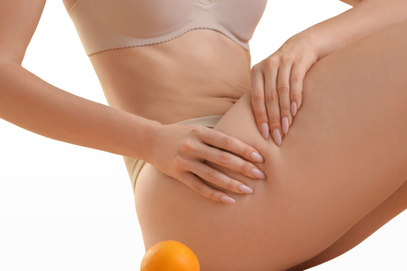 Get Summer-Ready Legs with Aveli Cellulite Reduction at The Falcone Center