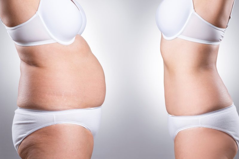 Tips for Choosing a Liposuction Doctor